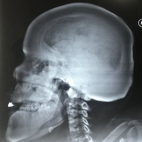 measuring skull thickness|why do skull bones thicken.